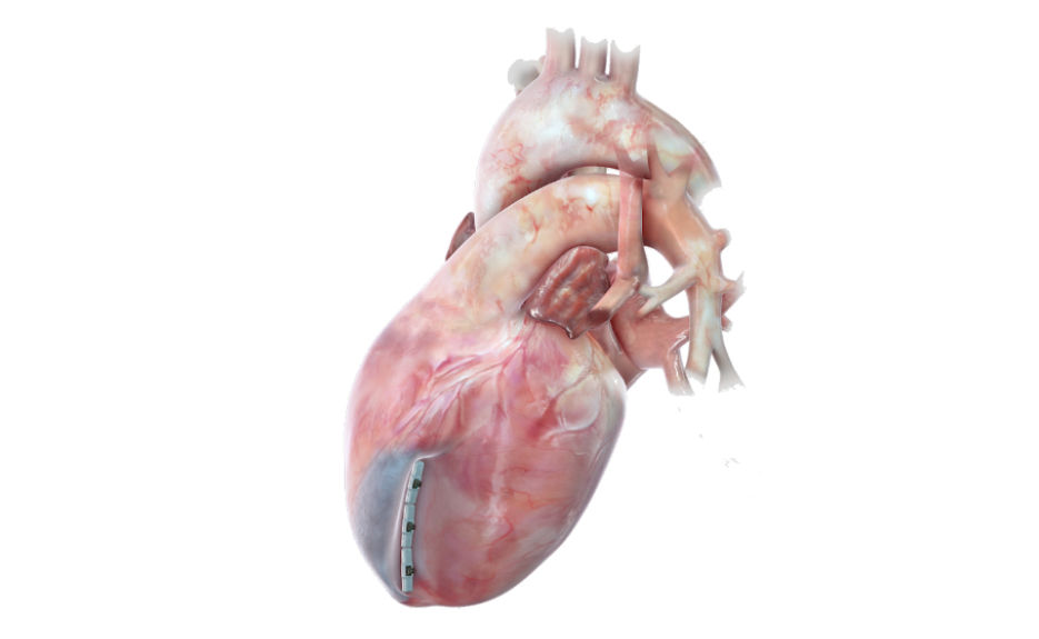 BioVentrix's Revivent TC Transcatheter Ventricular Enhancement System Receives FDA's Breakthrough Device Designation for Heart Failure